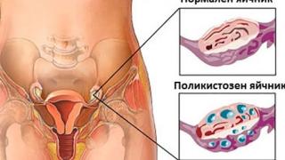Поликистозни яйчници! Гинеколозите алармират за следните симптоми, които да ви включат червената лампичка