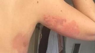 Австралийски модел и сестра й споделиха ужасяващи СНИМКИ след киселинната атака в нощен клуб в Лондон 
