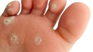 Ето най-ценните съвети за това как да се отървем от мазолите
