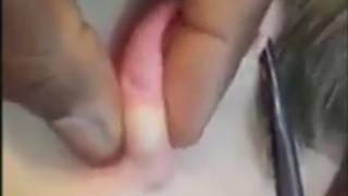 Жена имаше малка бучка на ухото, това, което излезе след като мъжът ѝ я стисна, е отвратително! (ВИДЕО)