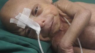 Бебе старец се роди в Бангладеш (СНИМКА)