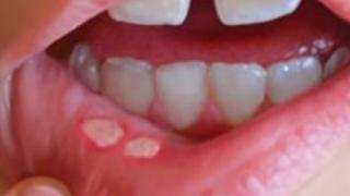 Невидими алайнери коригират криви зъби