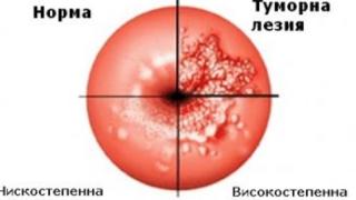 Дами, задължително прочетете тази статия! Ето ги първи симптом на рак на шийката на матката 