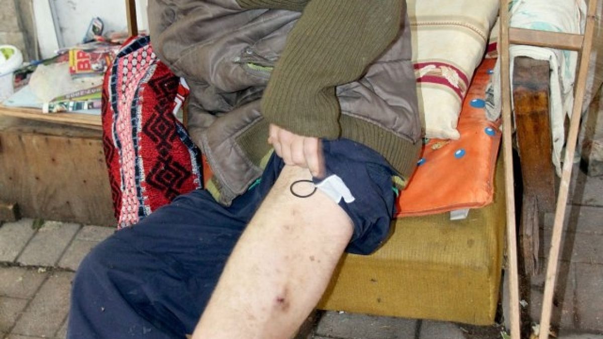 Млад пловдивчанин с абцес на крака гасне в гараж без ток