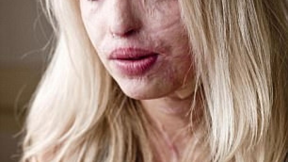 Обезобразена от киселина жена решава да се самоубие, но се случва нещо невероятно, което преобръща живота й! (СНИМКИ)