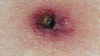 Иде сезонът на кърлежите, ето как да се опазим и какво да правим, ако ни ухапе