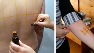 Как да лекуваме болните стави с йод?