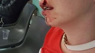 Еми отиде на парти, но приключи в болницата със 17 шева и обезобразено завинаги лице (СНИМКИ 18+)