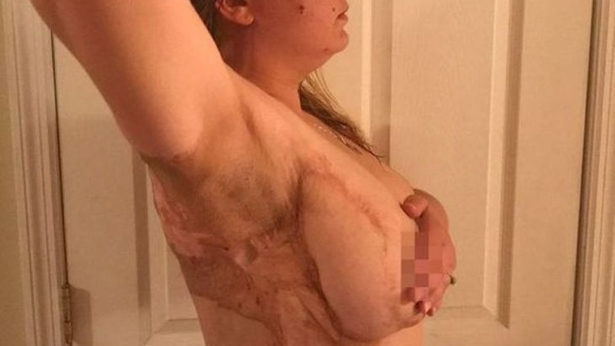 Покъртително! Родилно петно я подложи години наред на подигравки, но тя показа белязаното си голо тяло и... (СНИМКИ 18+)