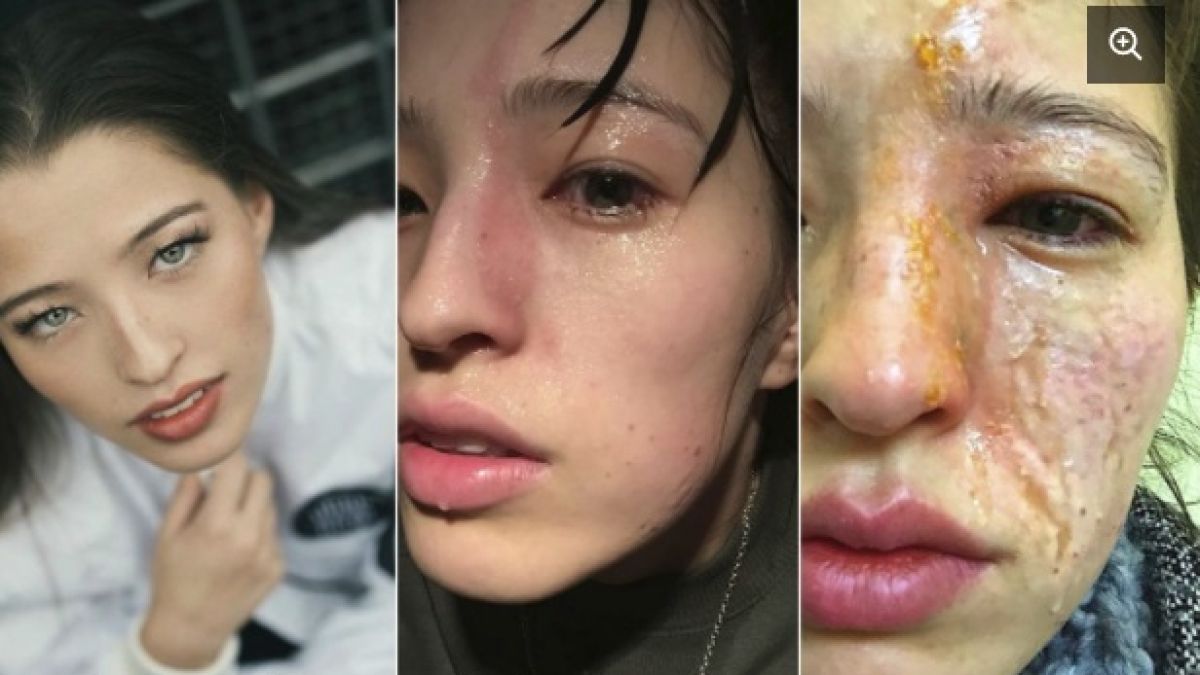 Ужасяващо! Лицето на красива моделка бе изпепелено от етерично пачулиево масло (СНИМКИ 18+)