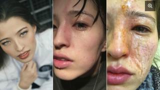 Ужасяващо! Лицето на красива моделка бе изпепелено от етерично пачулиево масло (СНИМКИ 18+)
