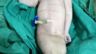 Аномалия: Индийка роди малка русалка (СНИМКИ 18+)