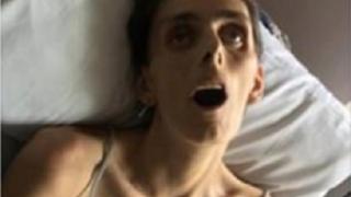 Фейсбук цензурира разтърсваща СНИМКА (18+) на млада жена, умираща от рак 