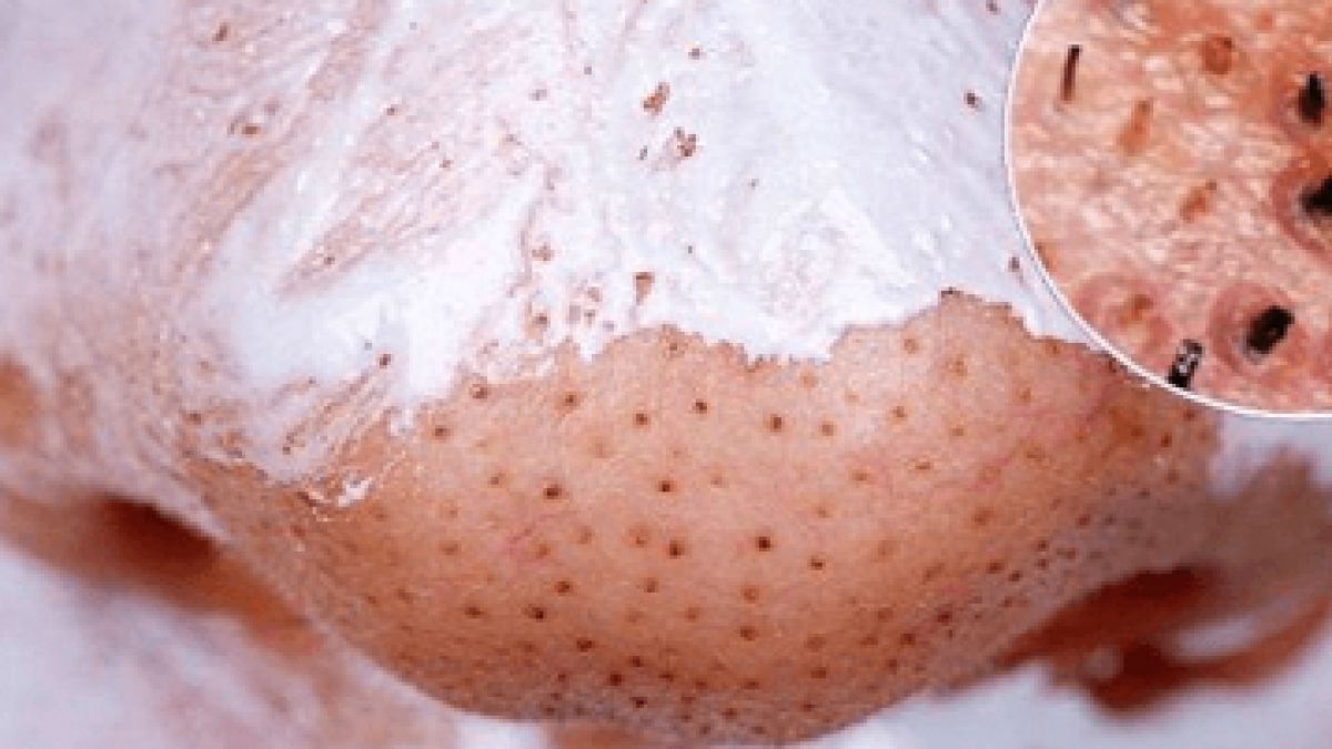 Лесна рецепта за маска от 2 продукта срещу черните точки по лицето