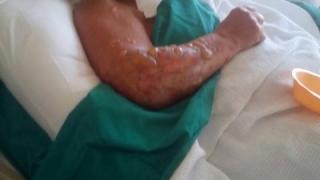 Кошмарна СНИМКА (18+) на обгорялата българка Елена в огнения гръцки ад!
