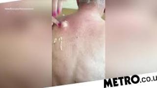 Най-отвратително! Спукаха огромна гнойна пъпка на 25 години (ВИДЕО)