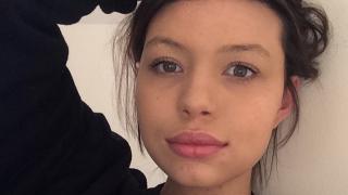 Красавица с тежка съдба: Мехурите по кожата ми сълзят с всяко докосване, но няма да се откажа от подиума (СНИМКИ)