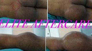 Млада британка реши да си направи евтино бразилско дупе и плати с живота си (СНИМКИ 18+)