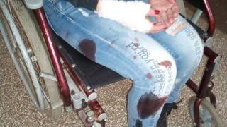 Бездомен пес наръфа жестоко жена в Пазарджик (СНИМКА 18+)