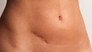 Може ли да се излекува апендицит с хапчета? Вижте отговора!