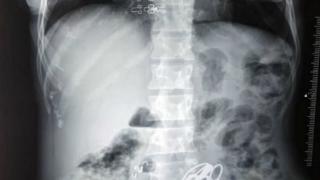 Жена отиде на лекар със силни болки в стомаха! Когато хирурзите я отвориха изгубиха ума и дума (СНИМКИ)