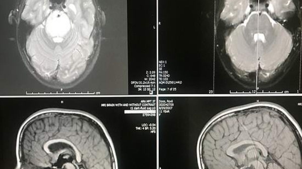 Чудо! 11-годишно момиченце се излекува от смъртоносна болест 