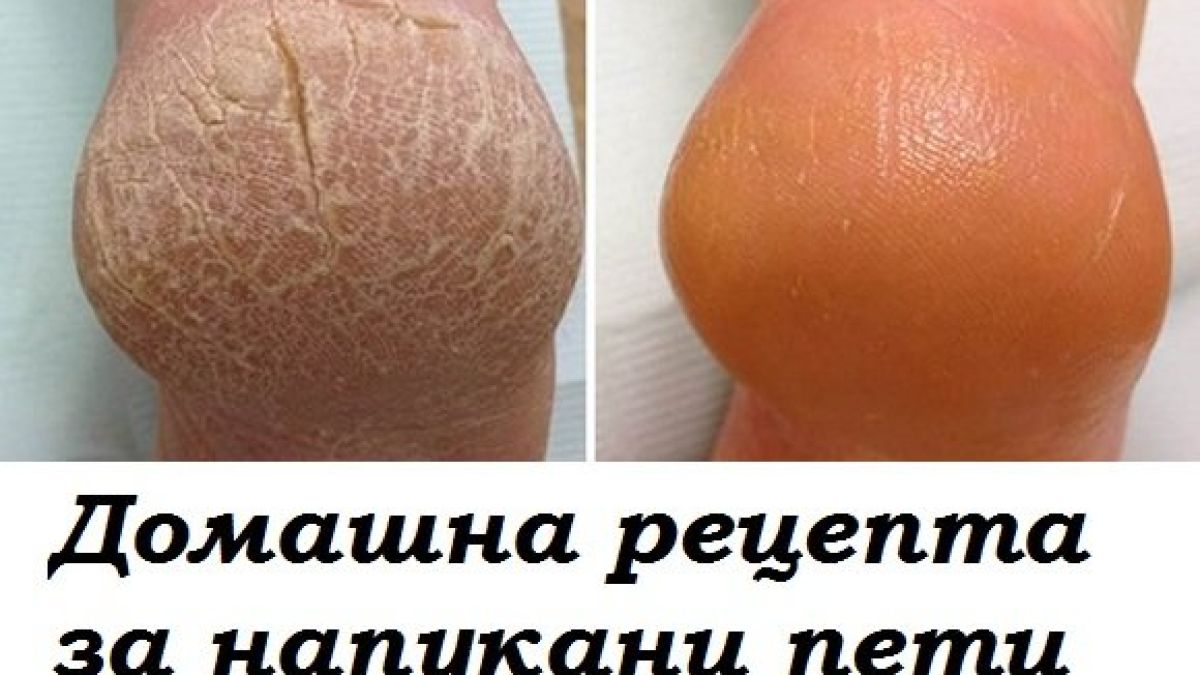 Как да се отървем от напуканите пети? Безотказна рецепта!