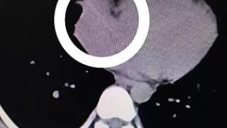 Младеж влезе в болница с 40 градуса температура! Когато хирурзите го отвориха, се хванаха за главата (СНИМКИ)
