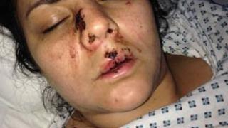 Приказна красавица, нападната от мъже на улицата, показа кървави СНИМКИ 18+ 