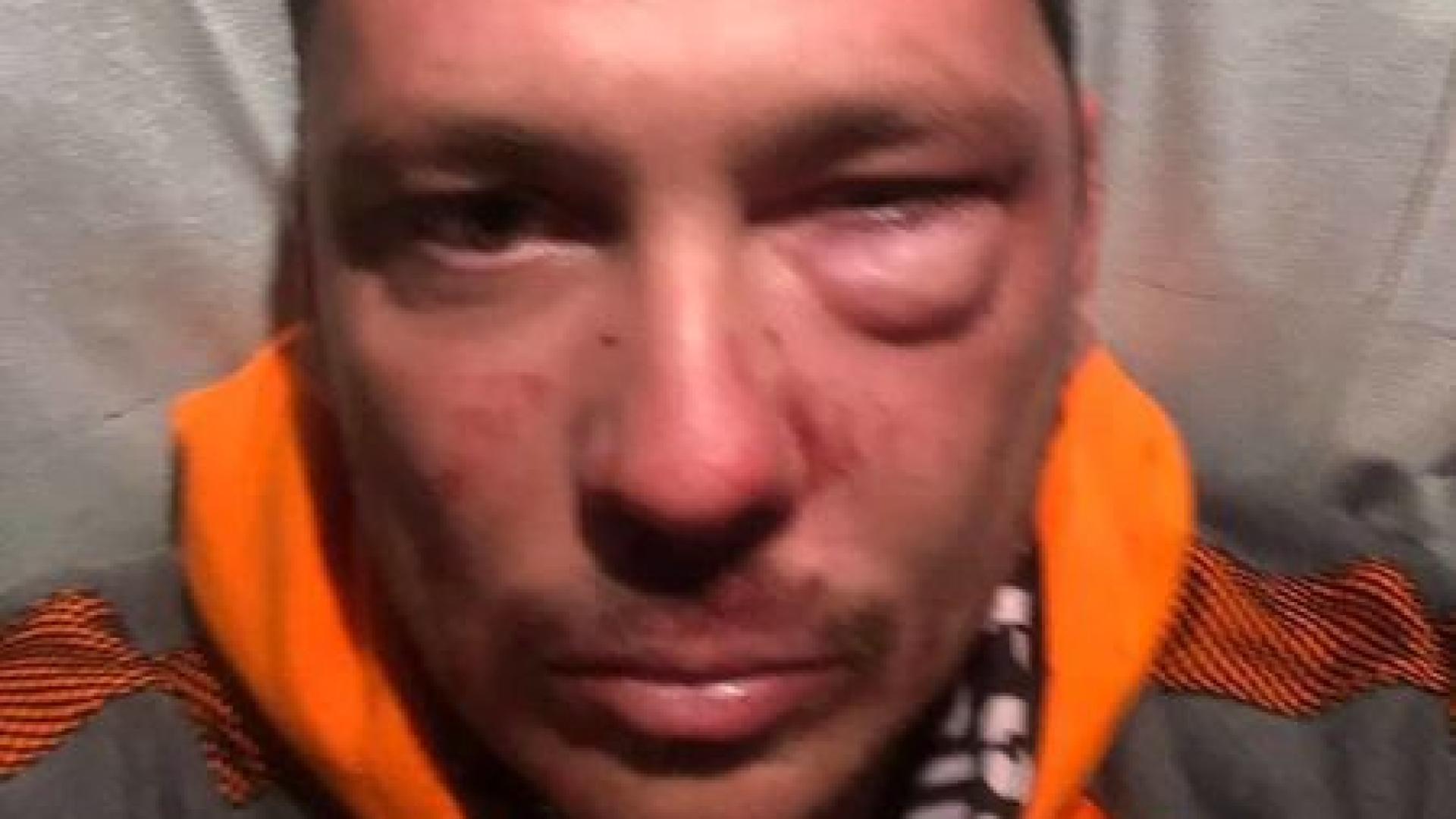 СНИМКА на бившия на Черната Златка с обезобразено лице шокира бургазлии 