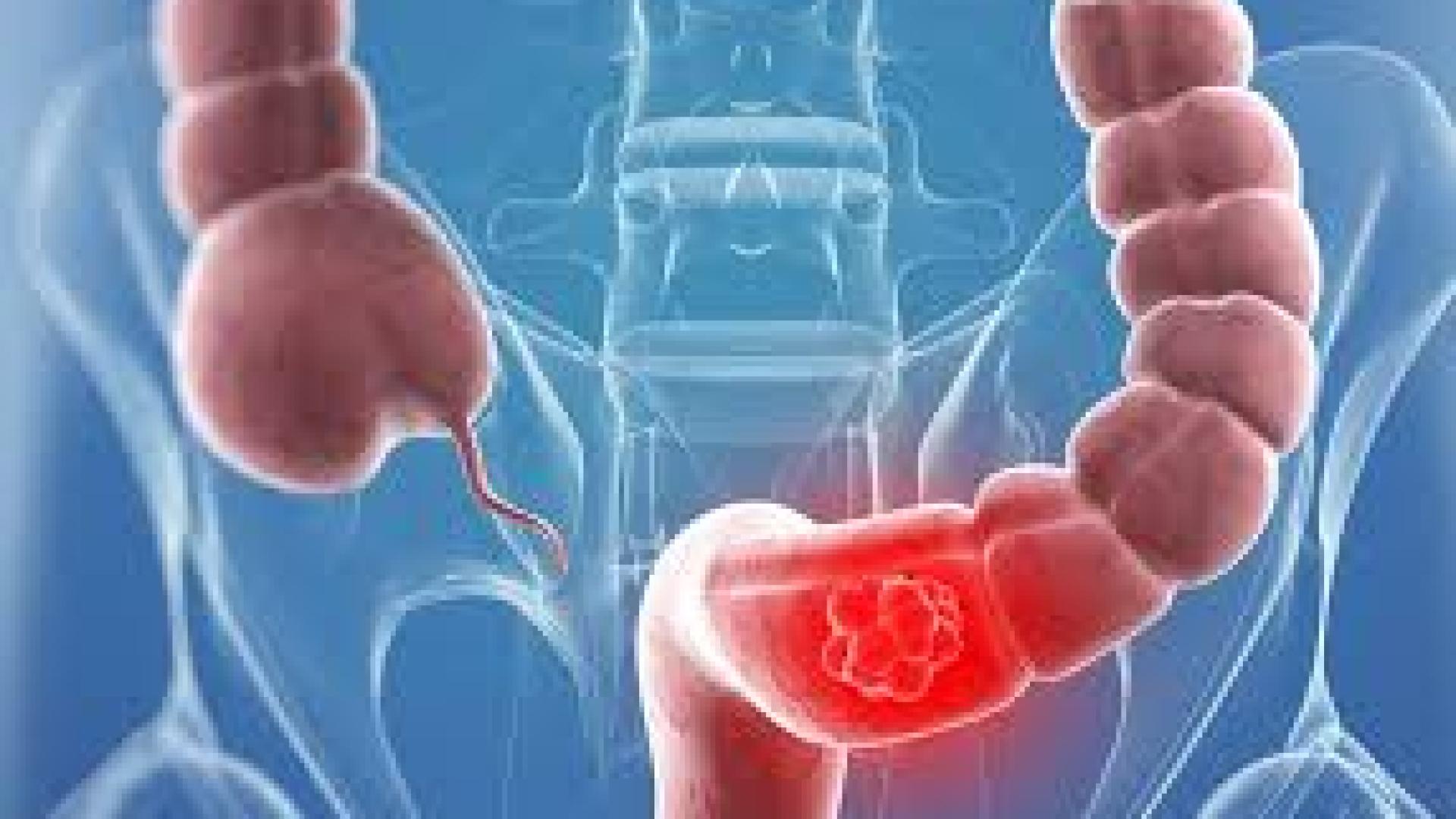 3 храни, които водят до рак на дебелото черво