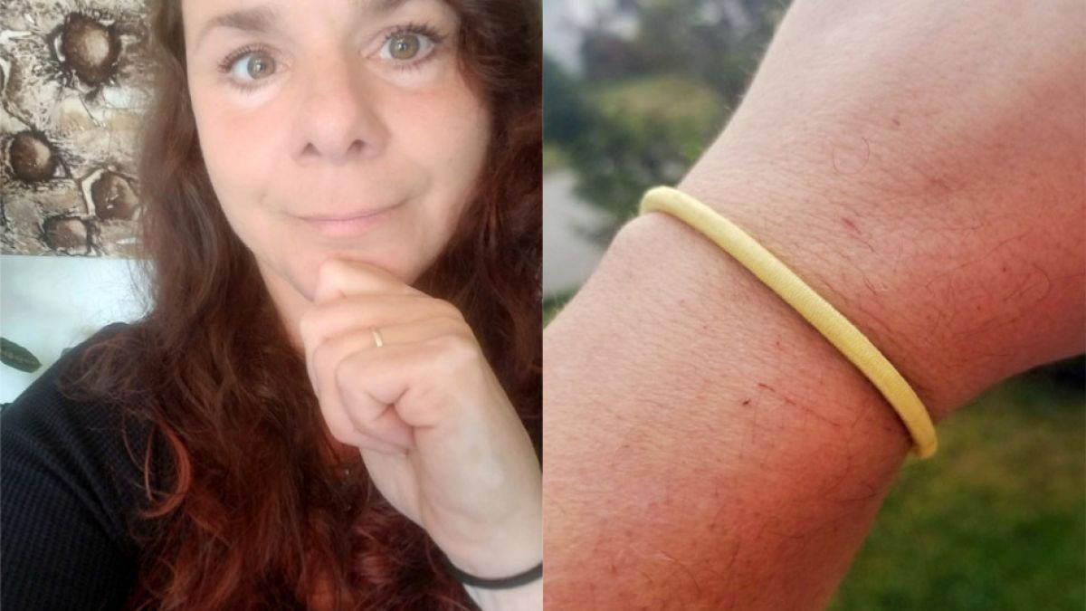 Жена съжали жестоко, че 30 г. е носила ластик за коса на ръката си 