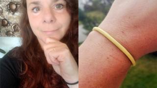 Жена съжали жестоко, че 30 г. е носила ластик за коса на ръката си 