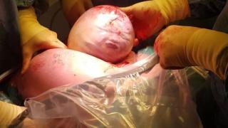 Родилка легна под ножа за секцио и реши, че е родила извънземно СНИМКИ 18+