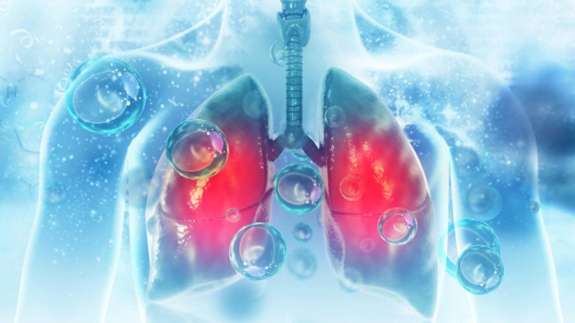 Д-р Николай Янев, д.м.: Нелекуваната ХОББ неминуемо води до дихателна недостатъчност