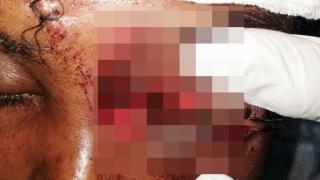 Тенджера под налягане се взриви и отнесе черепа на жена СНИМКИ 18+
