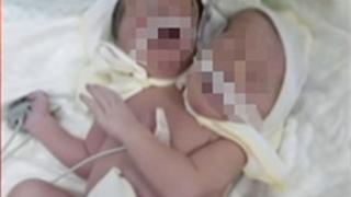 Бебе с две глави се роди в Украйна СНИМКА