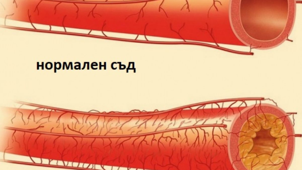 Само 50 мл. на ден от тази мощна напитка почиства артериите и предотвратява сърдечен удар!