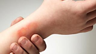 В никакъв случай не правете това при изгаряне