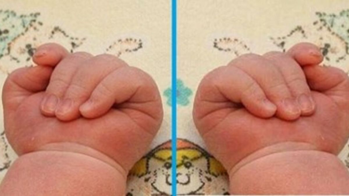 Уникална операция раздели сиамски близначки във Франция 