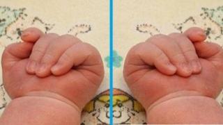 Уникална операция раздели сиамски близначки във Франция 