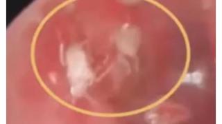 Мъж отиде в болница с болка в ухото, а щом докторите го прегледаха се хванаха за главата