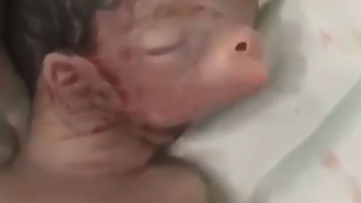Бебе се роди със свинска зурла и уши на врата ВИДЕО