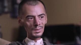 Страшна болест коси наред американски войници ВИДЕО