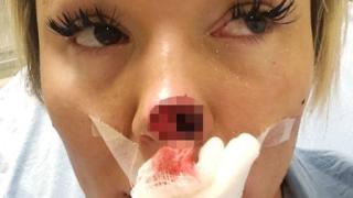 Ревнив психар отхапа носа на гаджето си - подозират, че го е изял СНИМКА 18+