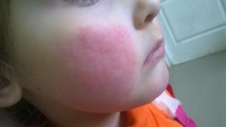 Страдания: Всеки 10-и в България с неописуема болка и нетърпимо сърбящи обриви