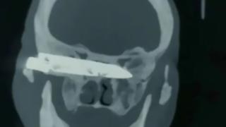 Фермер живя 26 години с 10-метров нож в главата ВИДЕО 