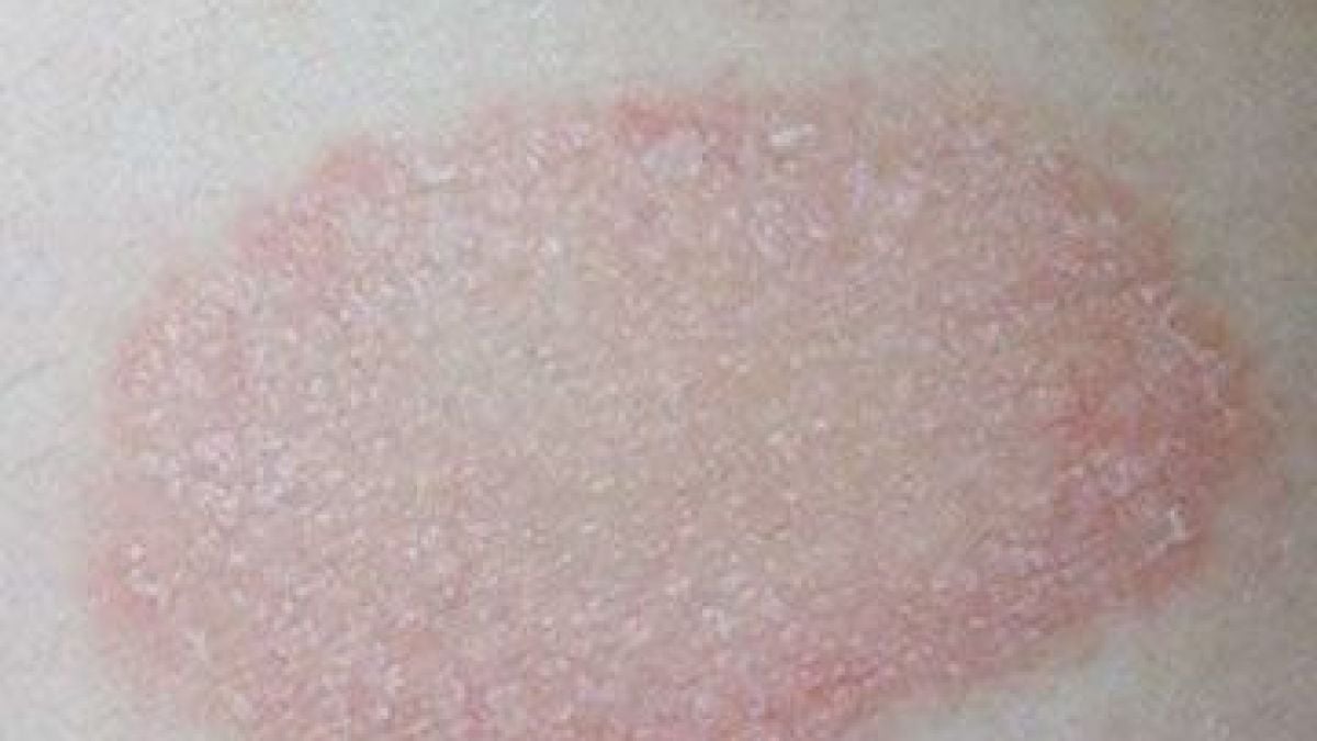 Не е за подценяване! Какво е розов лишей и защо се лекува трудно 