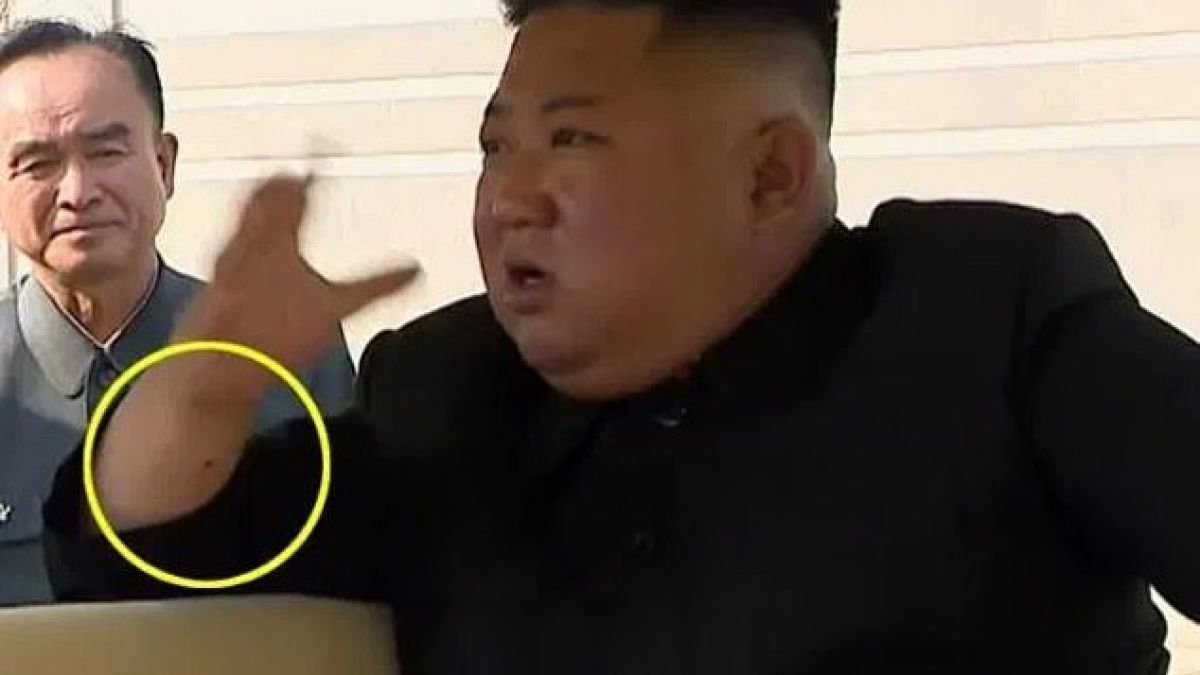 Медици видяха нещо на ръката на Ким Чен Ун и обясниха защо бе изчезнал СНИМКИ