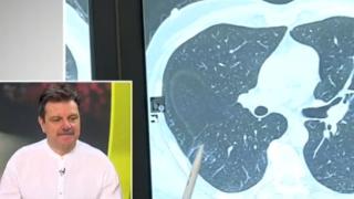 Пулмологът д-р Симидчиев: COVID-19 ще ни удари още 3 пъти! Веднага трябва да...